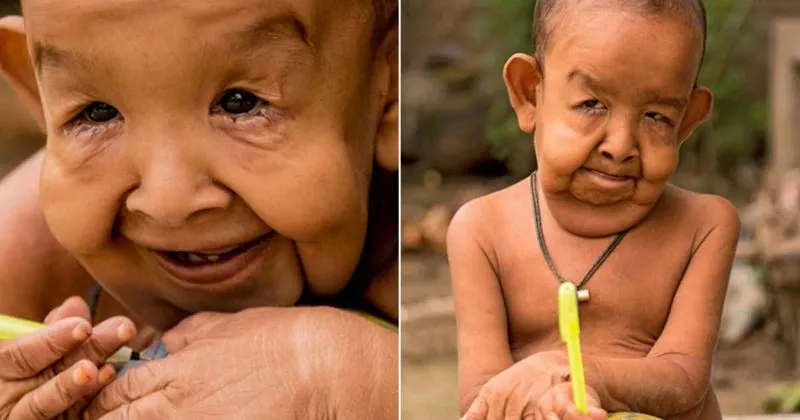 Balita Unik Berwujud Orang Tua, Mirip Kelainan Benjamin Button