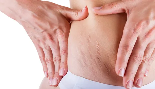 7 Bahan Alami Untuk Memudarkan Stretch Marks