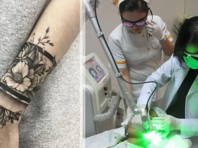 cara-menghilangkan-tato-