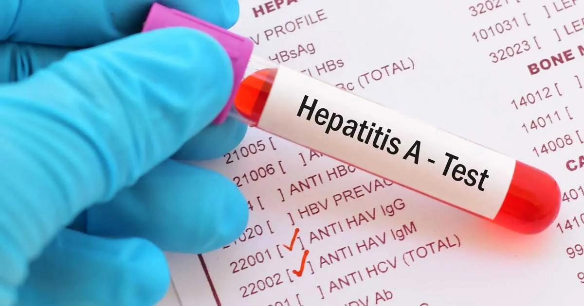 Sikap Dinkes Tanggapi Kasus Hepatitis A di Pacitan yang Hampir 1000