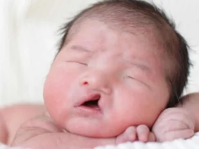 bayi-dengan-bibir-sumbing
