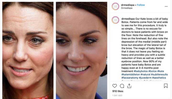 perawatan-wajah-kate-middleton-botox