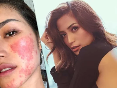 kondisi-wajah-jessica-iskandar-1