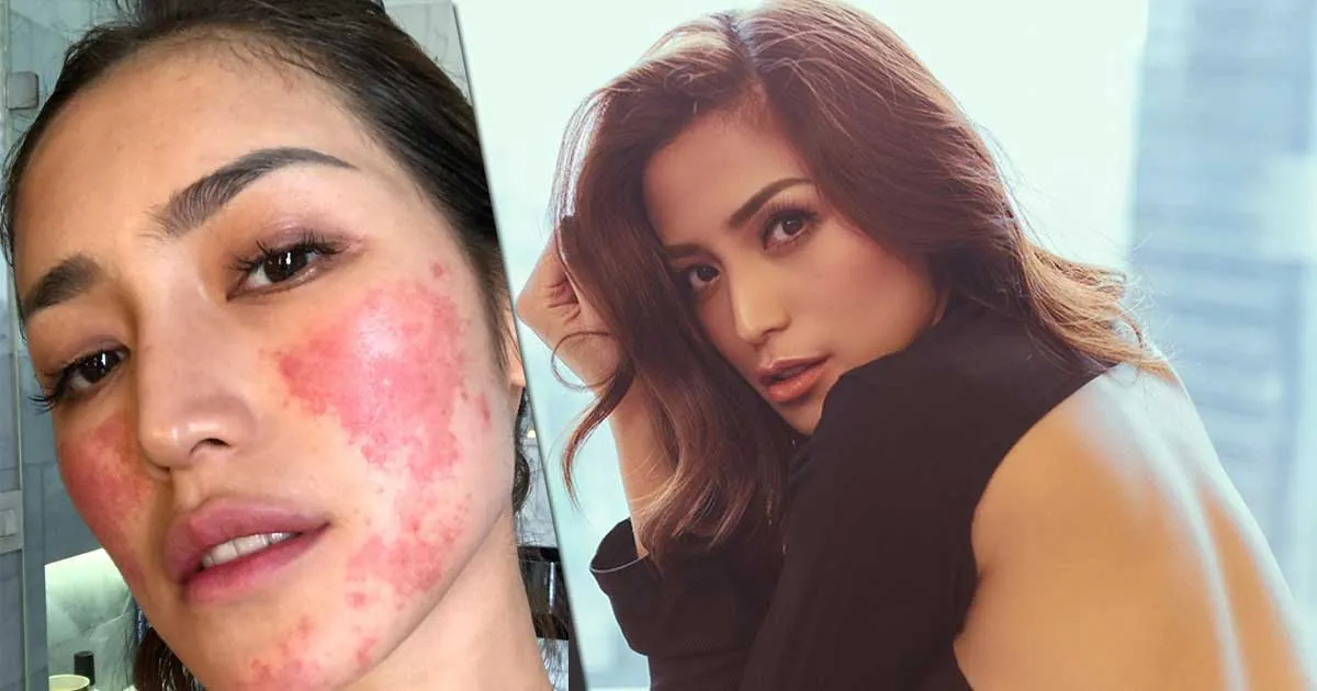Kondisi Wajah Jessica Iskandar Pasca Alergi Anestesi