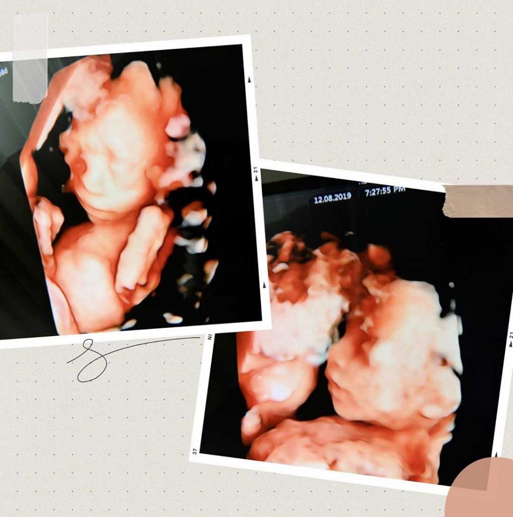 bayi-kembar-irish-bella-meninggal-dunia-1
