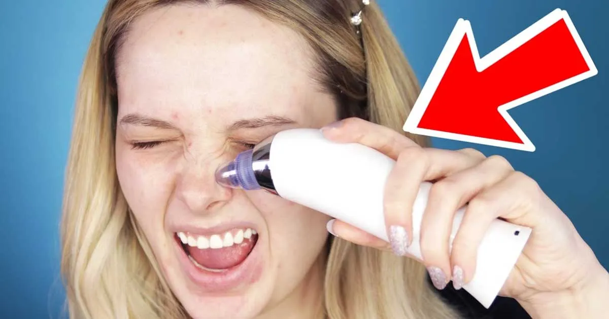 Apakah Pore Vacuum Efektif Usir Komedo? Ini Kata Dokter Spesialis Kulit