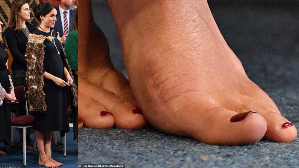 kaki-meghan-markle-operasi