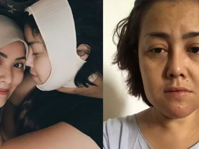 1-kakak-elma-theana-korban-malpraktik