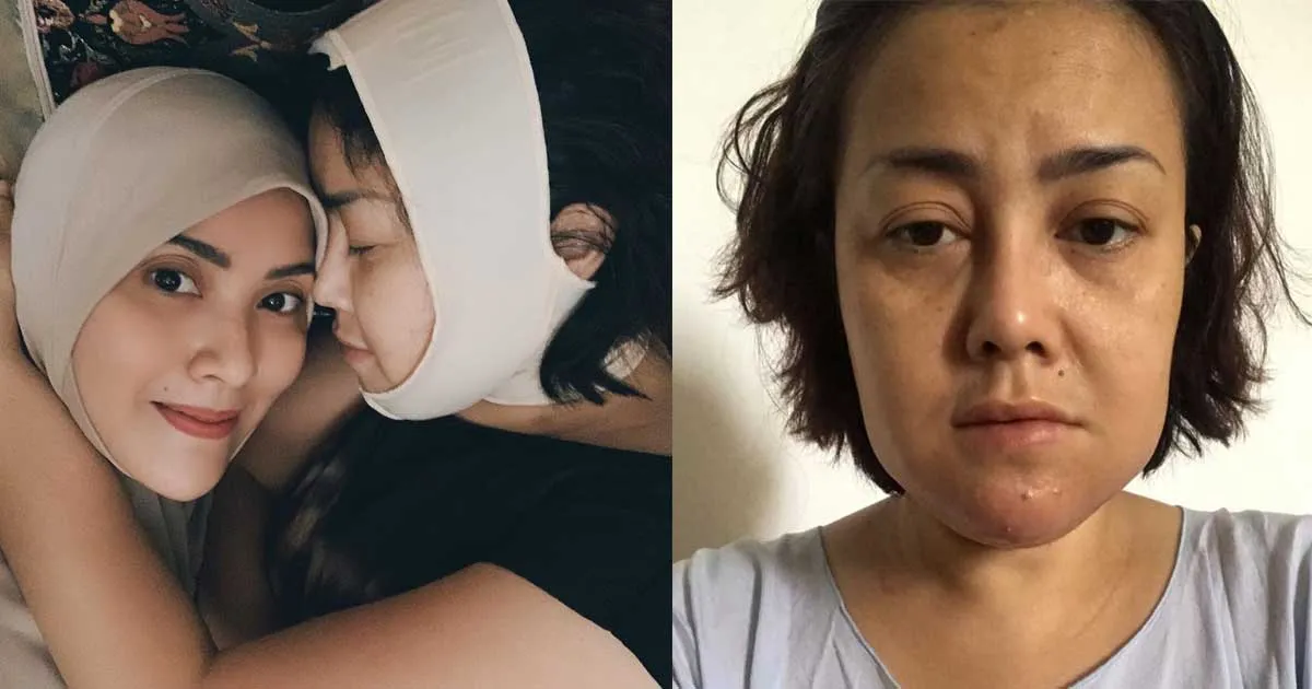 Kondisi Kakak Elma Theana Pasca Jadi Korban Malpraktik