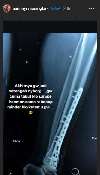 kondisi-sammy-simorangkir-pasca-operasi