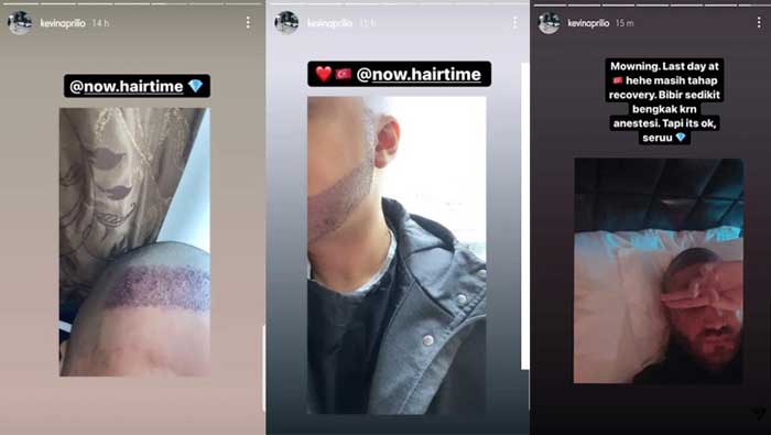 Rambut Kevin Aprilio