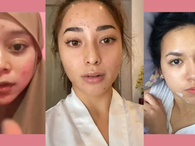 artis kulit jerawat berjerawat jerawatan