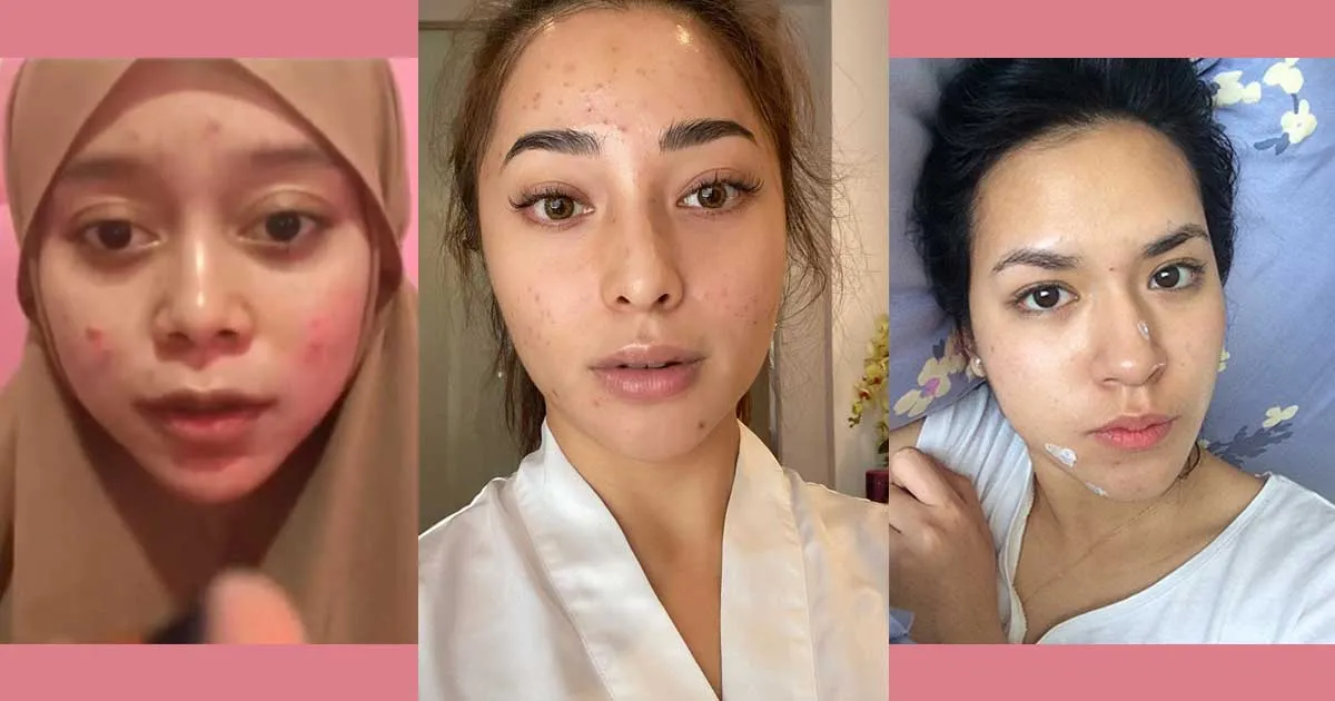 9 Artis yang Tetap Percaya Diri Meski Berjerawat