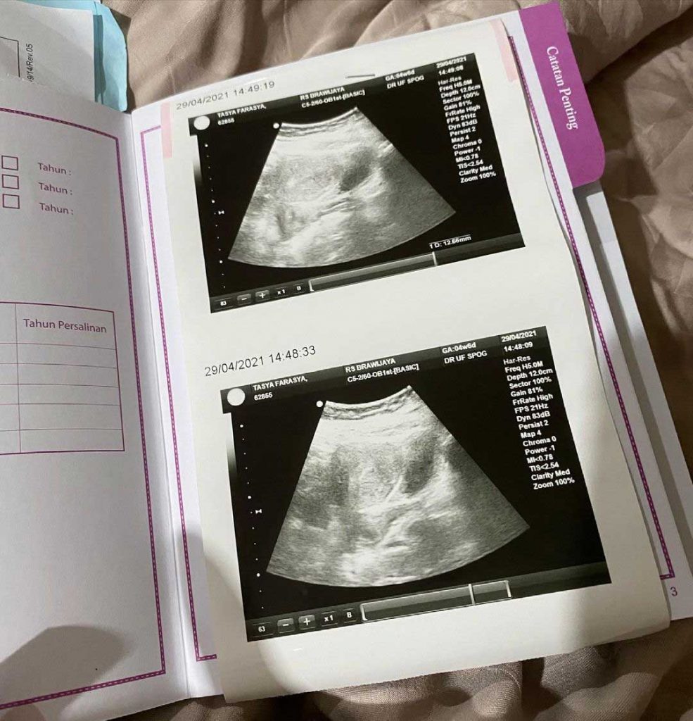 tasya farasya berduka keguguran'