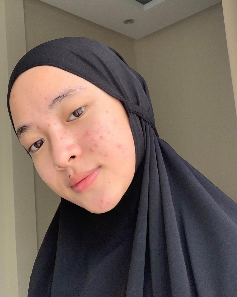 nissa sabyan jerawat wajah