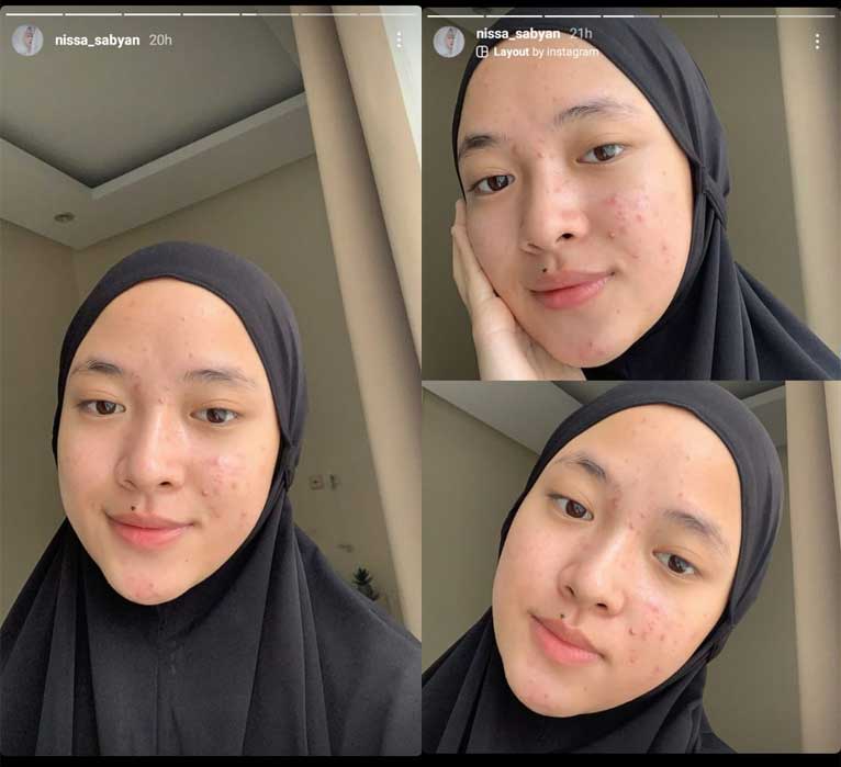 wajah foto nissa sabyan jerawat berjerawat