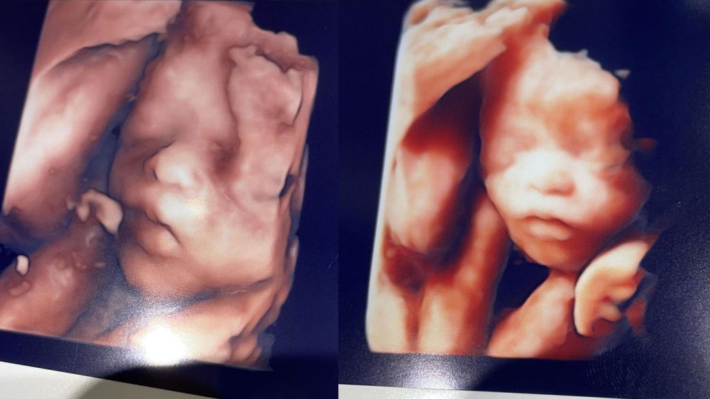 hasil-usg-bayi-anak-nathalie-holscher-dan-sule