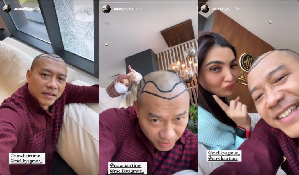 anang hermansyah botak