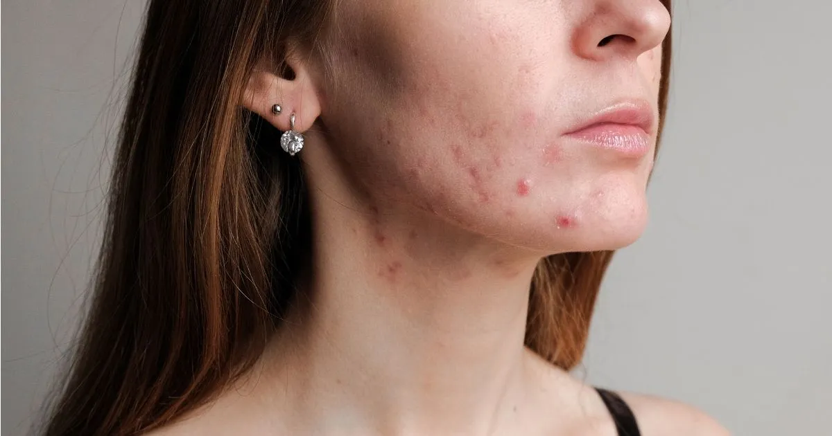 Hati-Hati! Fungal Acne Bisa Dipicu dari Pakaian Olahraga yang Kena Keringat