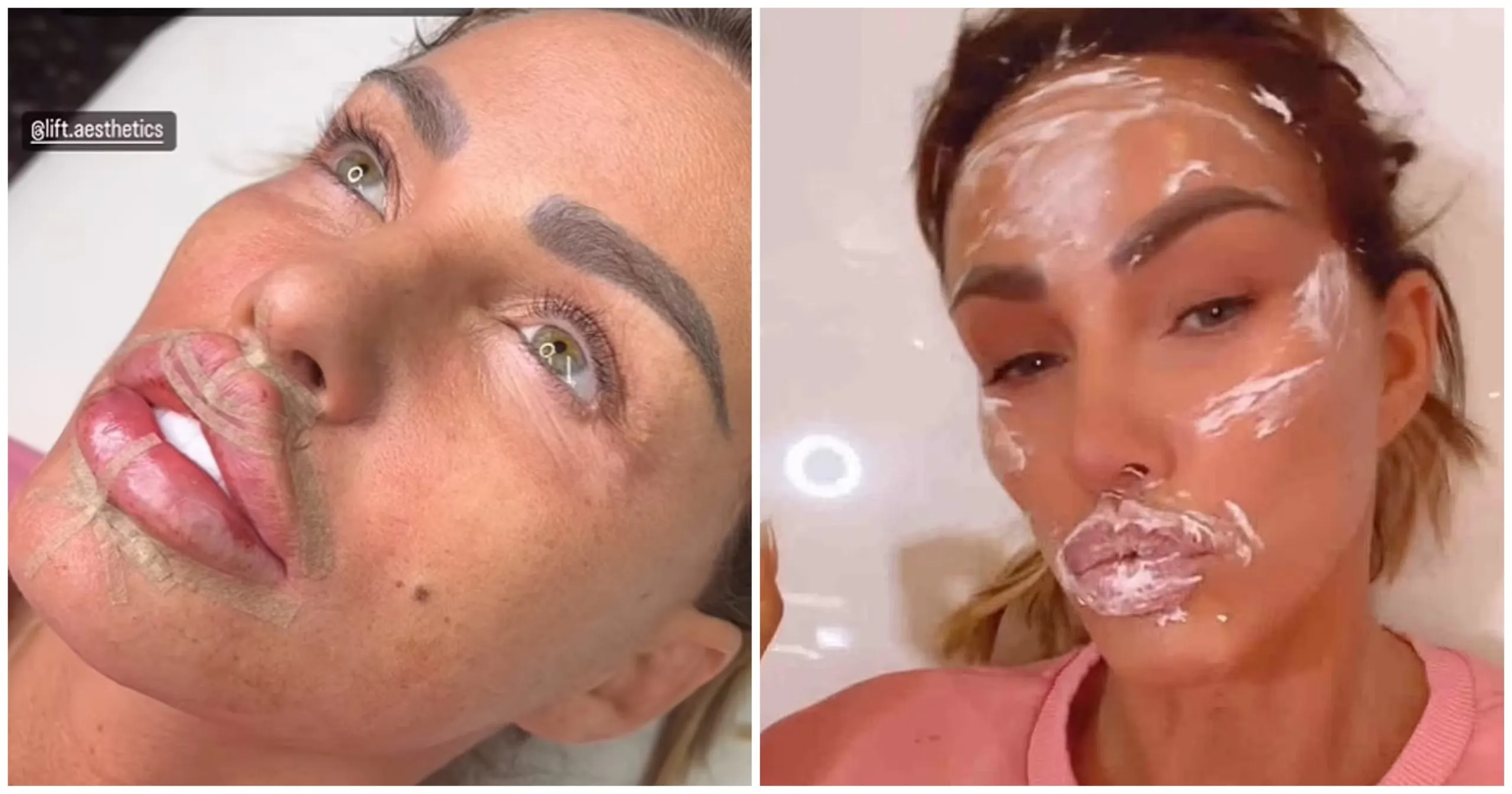 Bahaya Filler Bibir Kupu-Kupu yang Sedang Digandrungi Seleb Hollywood