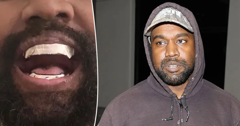Penampakan Gigi Titanium Kanye West Seharga Rp13 Miliar
