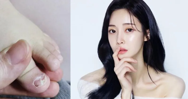 Areum ‘T-Ara’ Ungkap Mantan Suami Lakukan KDRT di Luar Nalar
