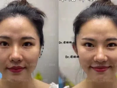 BEFORE AFTER: Seorang wanita melakukan filler kulit untuk mendapatkan telinga peri atau elf ears. (Foto: Vice/Time Plastic & Cosmetologi Hospital)