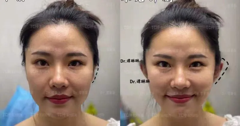 Obsesi Kecantikan, Para Wanita di China Ingin Bentuk Telinga Peri