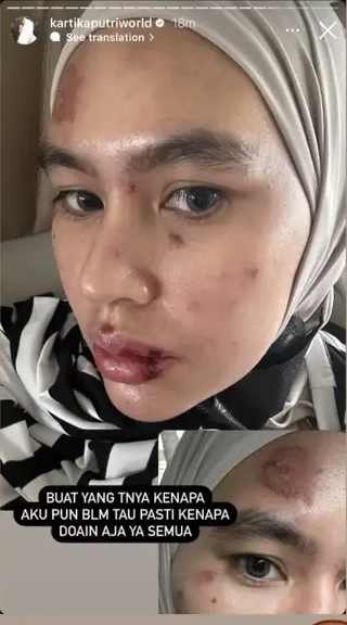 Kondisi wajah Kartika Putri saat terkena penyakit. Foto : Instagram/kartikaputriworld
