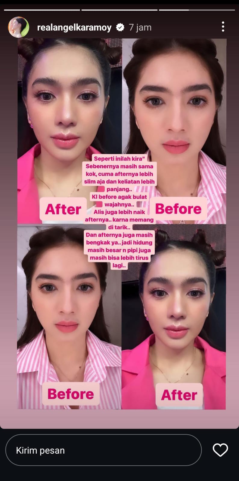 Potret wajah before after Angel Karamoy. (Foto: Tangkapan layar Instagram story/realangelkaramoy)