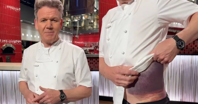 Hampir Mati dalam Kecelakaan Sepeda, Gordon Ramsay Tunjukkan Memar Mengerikan