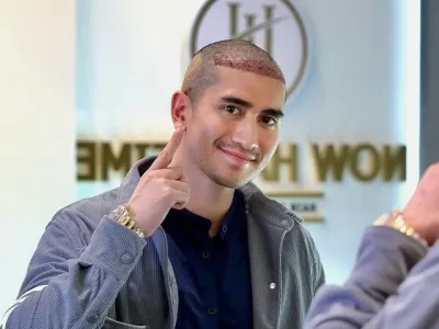 Verrell Bramasta menunjukkan transplantasi rambut yang dijalaninya. (Foto: Instagram/verrell)