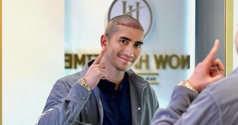 Verrell Bramasta Jalani Transplantasi Rambut, Disebut Mirip Zayn Malik