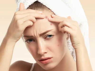 Pimple patch efektif untuk atasi jenis jerawat tertentu. Foto: Dok. Freepik