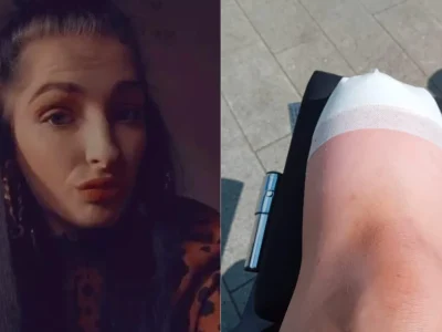 Kaki Wanita muda asal Inggris harus diamputasi karena luka lecet saat memakai sepatu. Foto: Dok. Hulldailymail