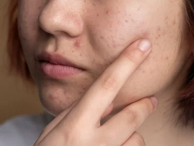 Atasi bekas jerawat menghitam dan dapatkan kulit halus mulus kembali (Foto: Freepik)