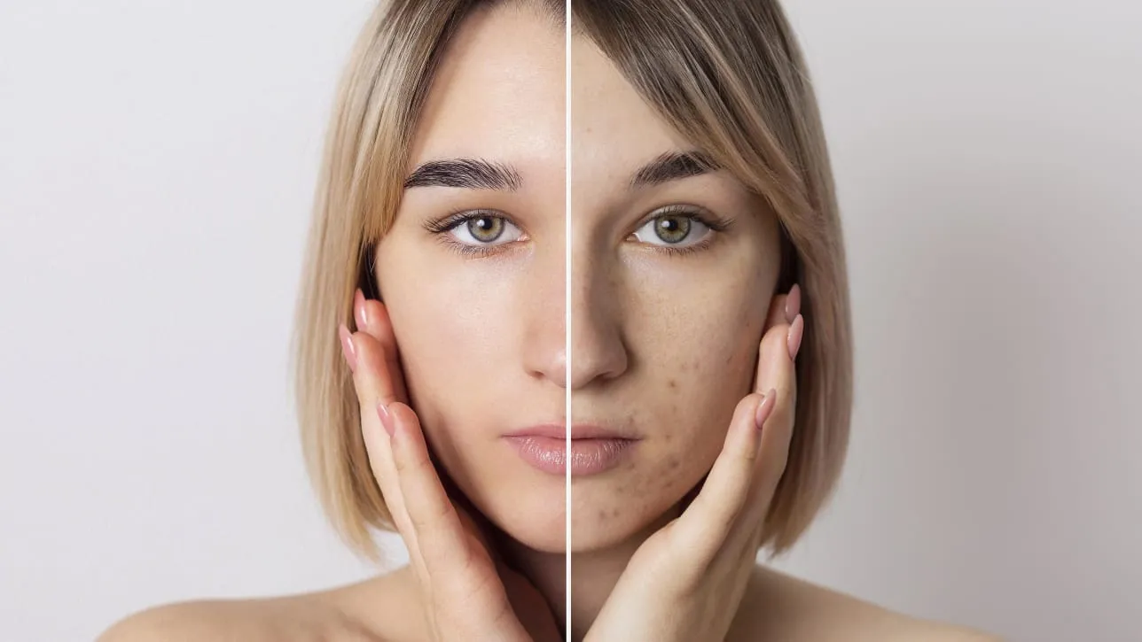 Pakai Skincare Malah Jerawatan? Bisa Jadi Ini Penyebabnya