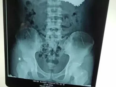 BERSARANG DI PERUT: SH (22), warga Kabupaten Indramayu yang sengaja memakan paku sebanyak 70 batang. Foto : Istimewa