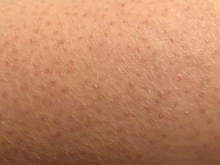 Kulit yang menderita keratosis pilaris. Foto: Dok. Wikipedia