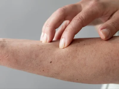 Cara menghilangkan keratosis pilaris. Foto: Dok. Freepik