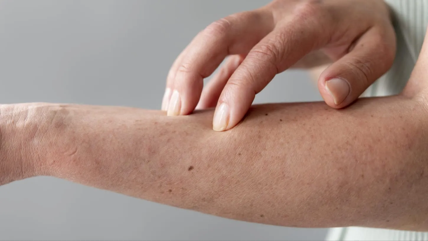 Cara Mudah Menghilangkan Chicken Skin atau Keratosis Pilaris