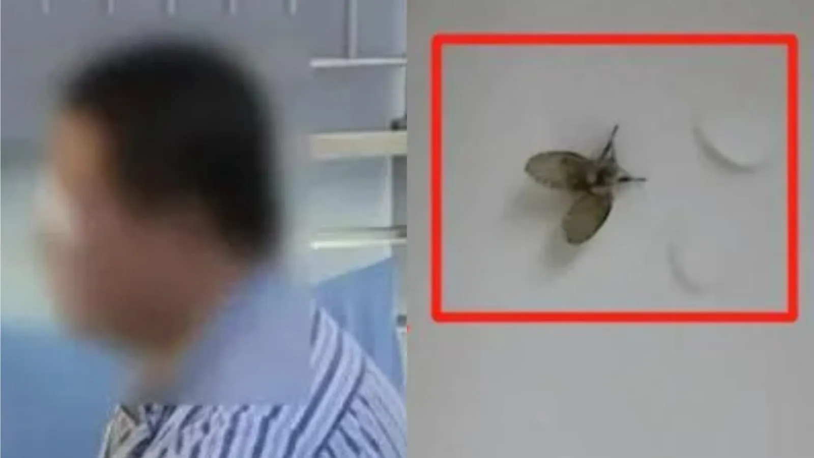 Pukul Lalat di Wajah, Pria di China Kehilangan Satu Mata