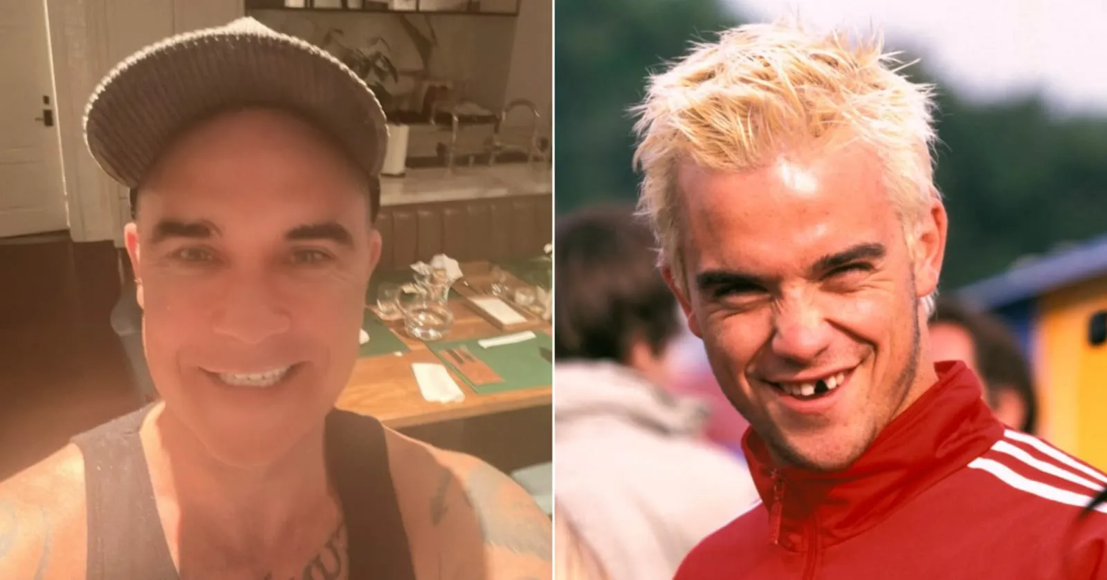 Puluhan Tahun Tak Dirawat, Kini Robbie Williams Pamer Gigi Baru