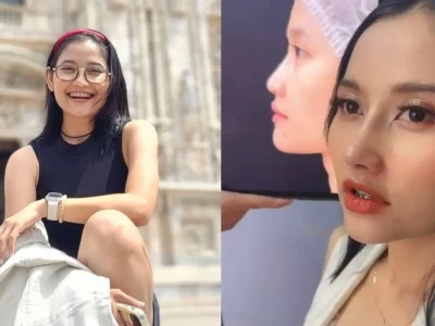 Riyuka Bunga oplas hidung. Foto: Dok. Instagram @riyukabunga