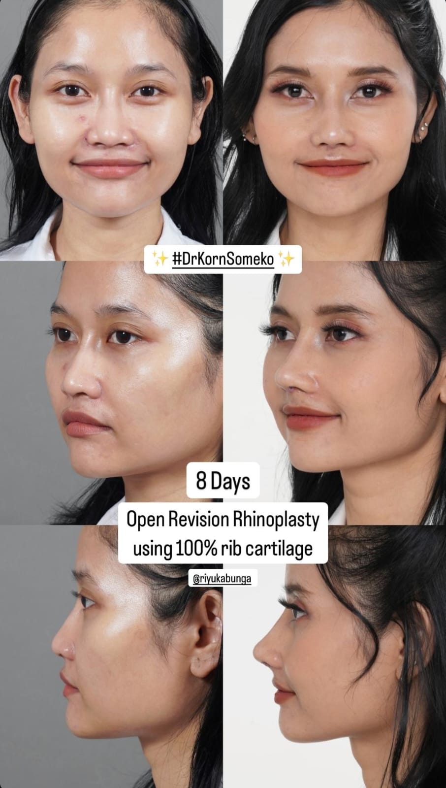 Perbedaan hidung sebelum dan setelah oplas. Foto: Dok. Instagram @somekoclinic_indonesia
