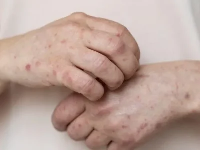 Ilustrasi penderita cacar monyet atau monkeypox (Mpox). Foto : Istimewa