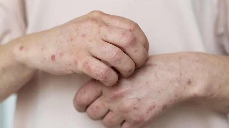 WHO Sebut Percikan Air Liur Bisa Jadi Jalur Penyebaran Mpox