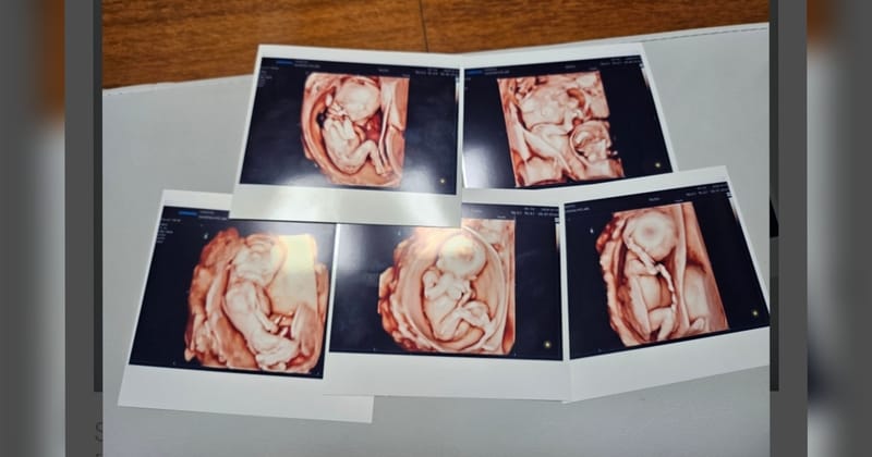 Hasil sonogram anak Kim Joon Yeong dan Sagong Hye Ran (Foto: Dok. Korea JoongAn Daily)