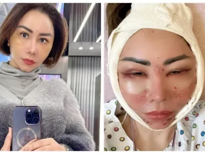 Potret terbaru Femmy Permatasari pasca menjalani oplas sebanyak enam kali dalam sehari. (Foto: Instagram)