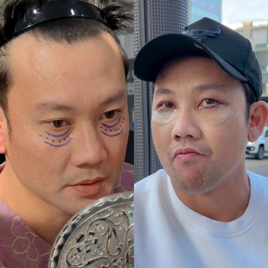Potret terbaru Denny Sumargo saat dan setelah melakukan oplas kantung mata (Foto: Instagram/sumargodenny)